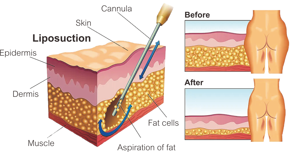 Rękojeść do lipolizy laserowej 