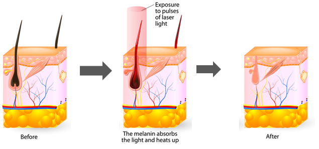 Zasada działania lasera diodowego 810 nm