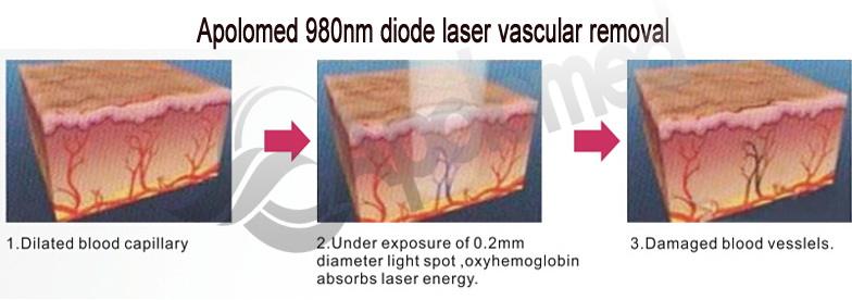 Laser diodowy 980nm naczyniowy