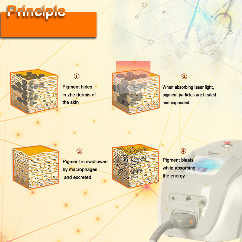 q przełącznik usuwania tatuażu 