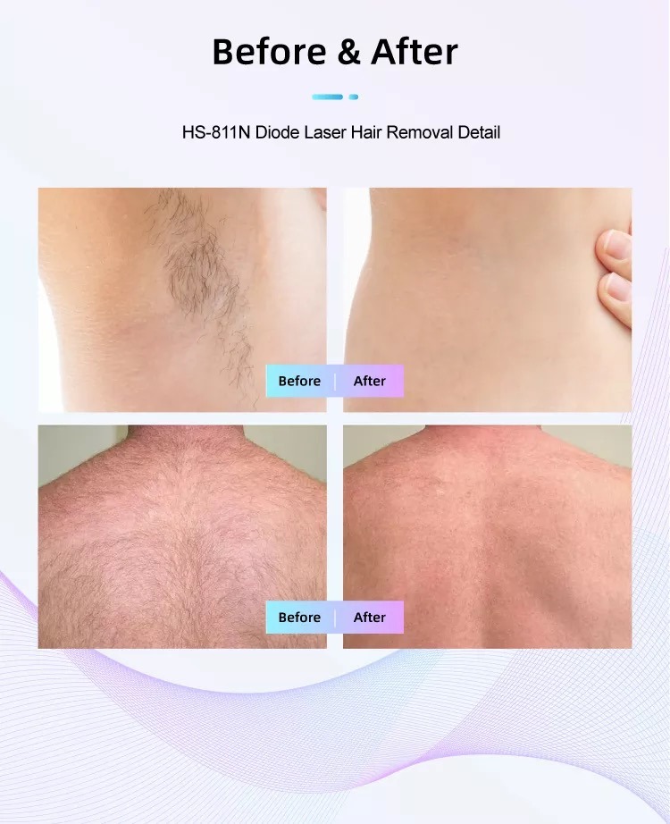 Fabryka maszyn do depilacji laserem diodowym HS-811