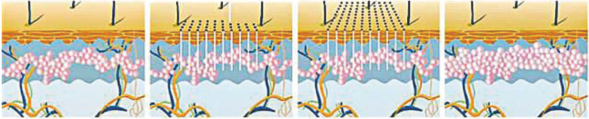 Laser światłowodowy erbowy 1550 nm ---- Głęboka przebudowa